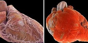تفاوت آشکار بین قلب سالم و بیمار در یک عکس