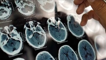 راهکار مؤثر برای پیشگیری از فراموشی و آلزایمر