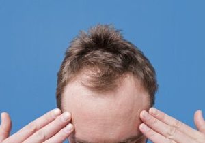 کدام ریزش مو در مردان شایع‌تر است؟