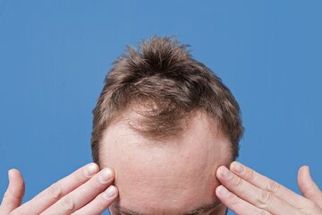 کدام ریزش مو در مردان شایعتر است؟