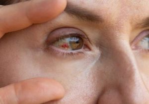 دلایل پارگی رگ خونی در چشم/ چه موقع باید به پزشک مراجعه کنیم؟